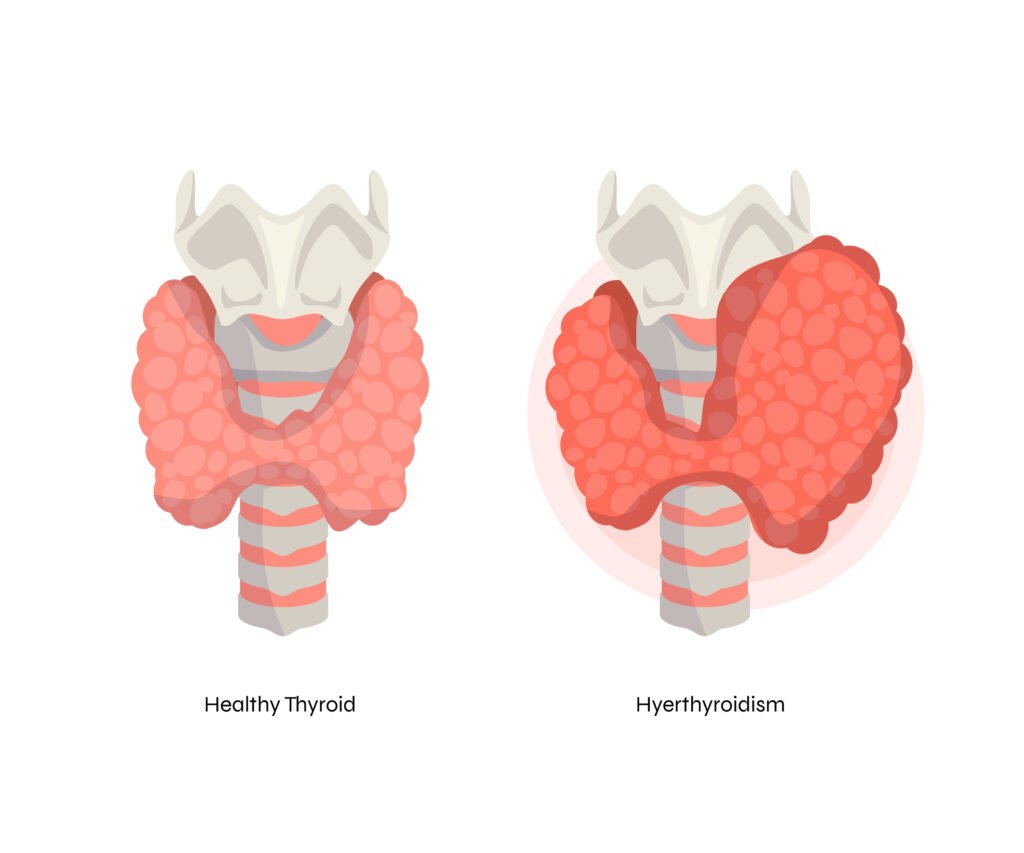 A healthy thyroid and an unhealthy thyroid, Hyperthyroidism